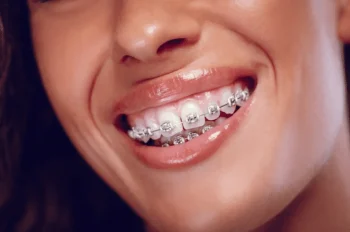 brackets metal